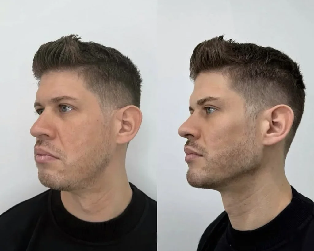 Harmonização full face - Full Face Harmonização Corporal Estética São Paulo Jardim Paulista