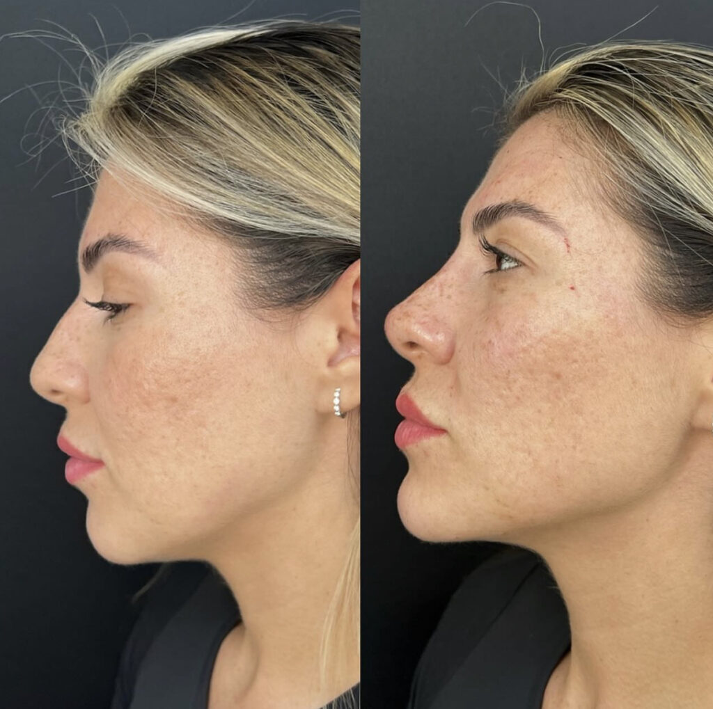 Mandíbula - Full Face Harmonização Corporal Estética São Paulo Jardim Paulista